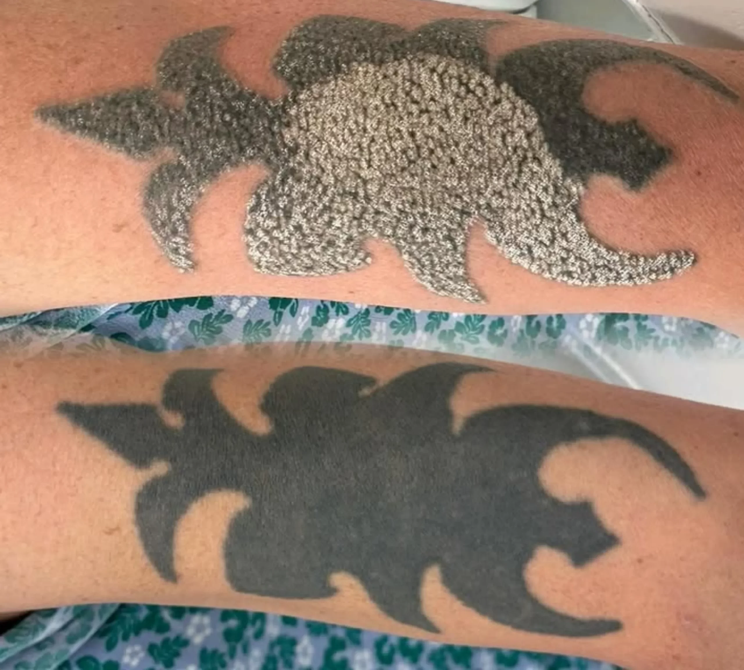 saline vs laser tattoo removal healing