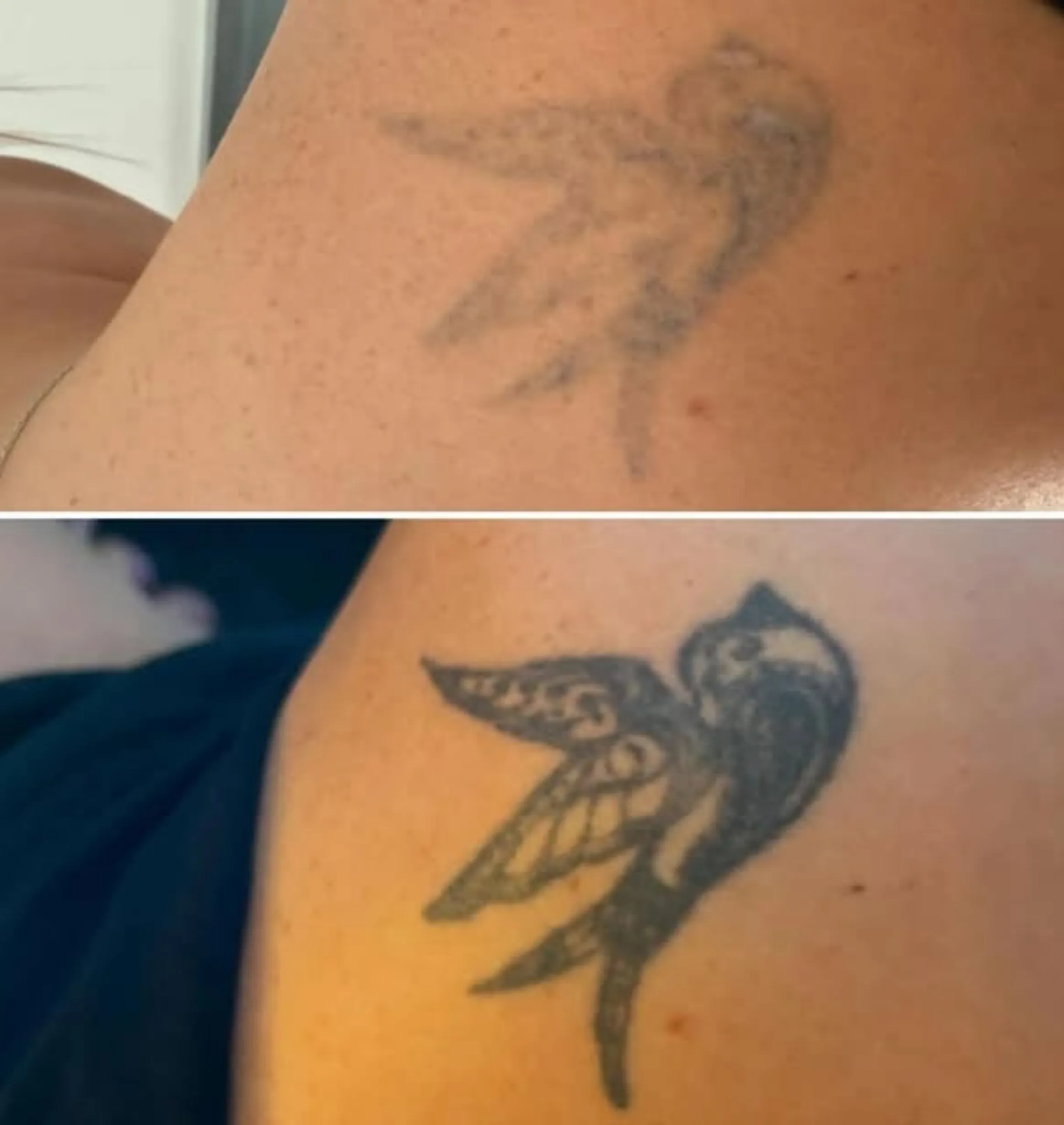 laser tattoo removal side effects