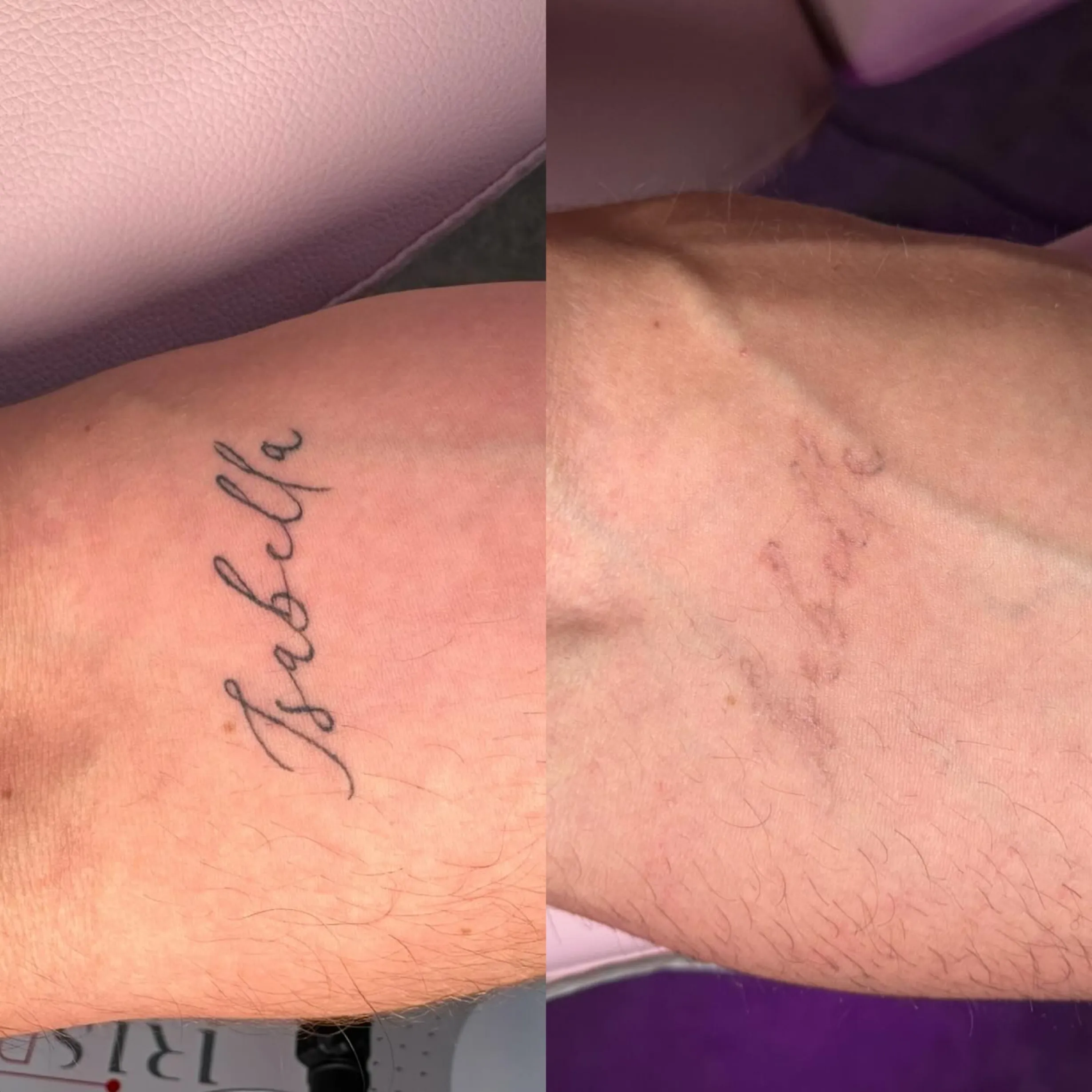 how does the body remove tattoo ink