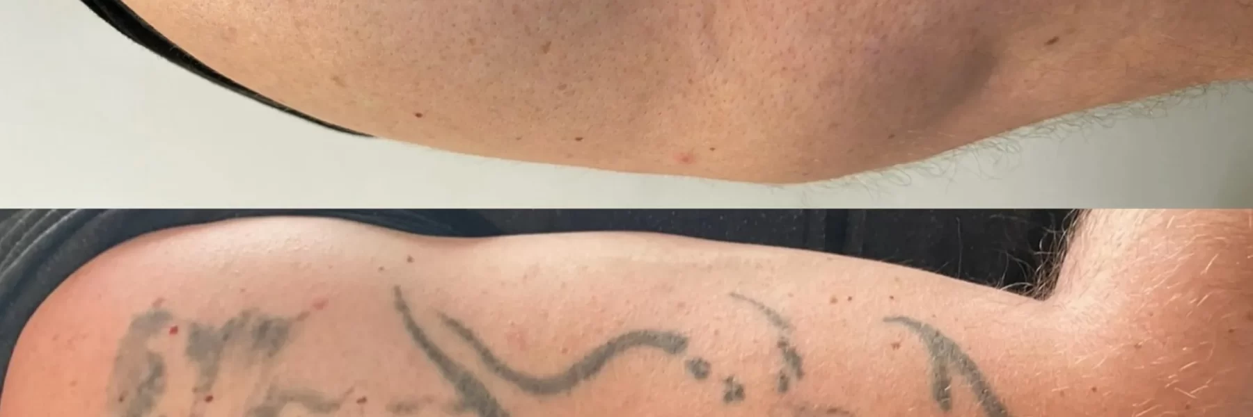 is tattoo removal bad for your liver